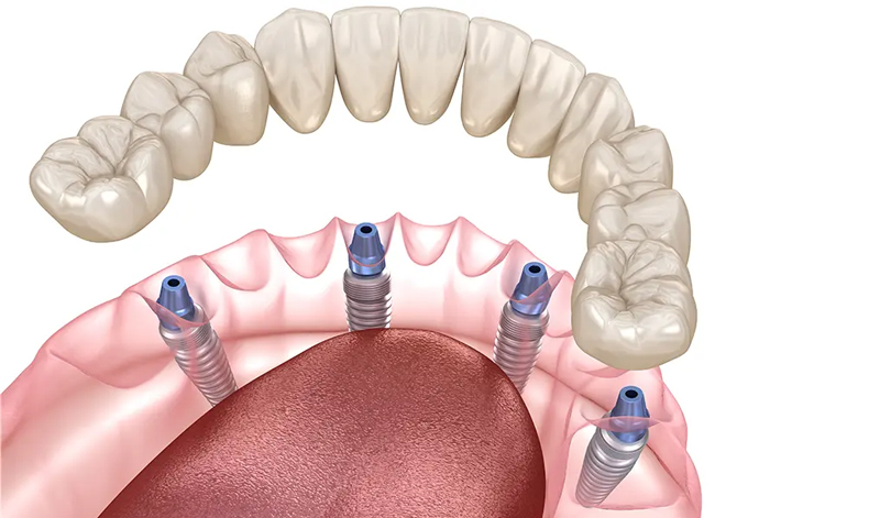 All-on-4について