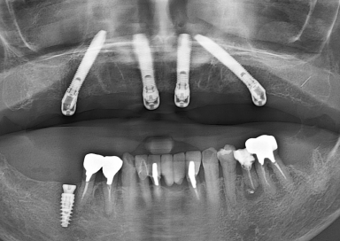 All-on-4について