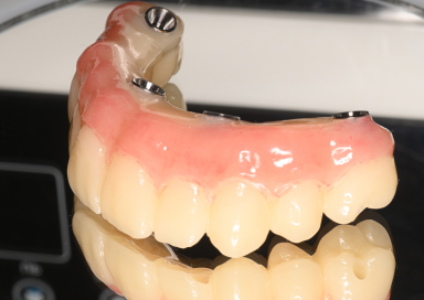 All-on-4について