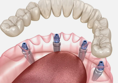 All-on-4について