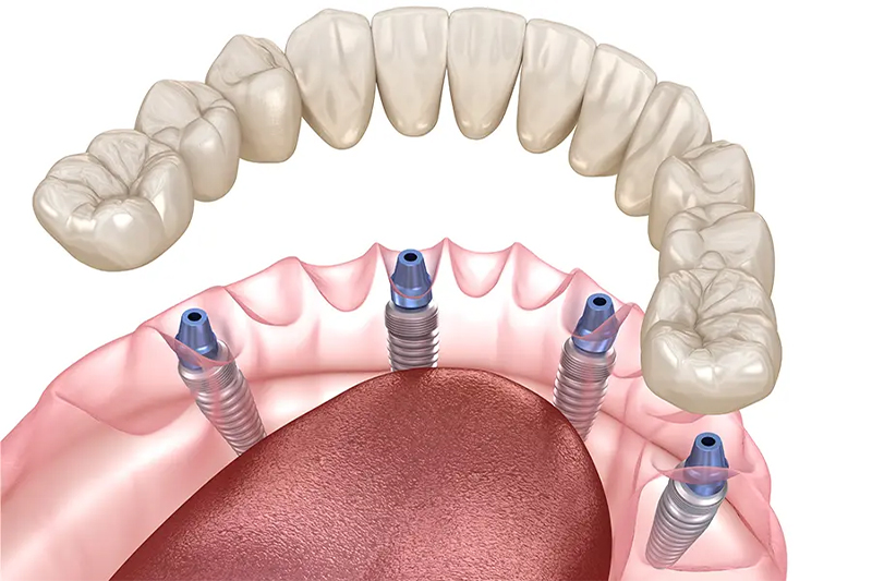 インプラント埋入手術（4本）＋当日仮歯装着