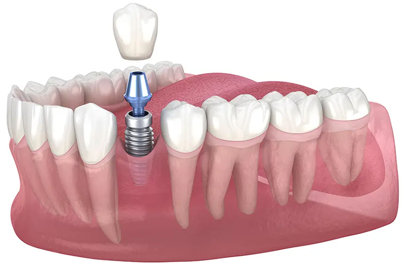 最終の人工歯（上部構造）装着