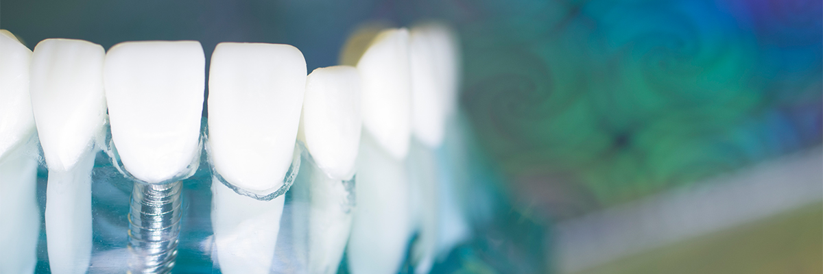 状態に合わせた最適なインプラント治療を