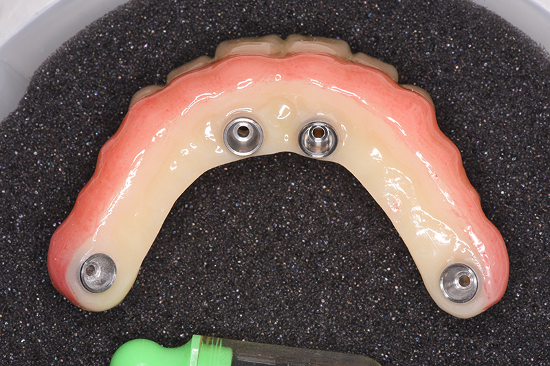 骨が少ない方にも対応できる先進埋入技術